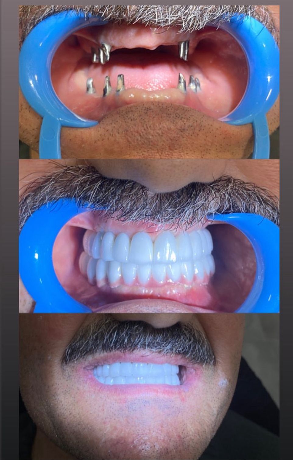 Diş implantı